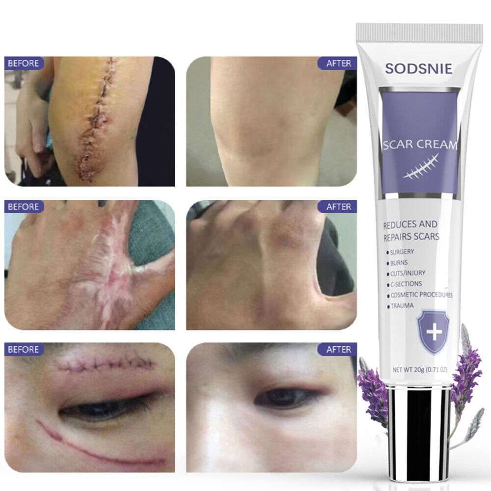 Scar Removal Cream: Repairing Burns, Scratches, Pimples, & Scars for All Skin Types