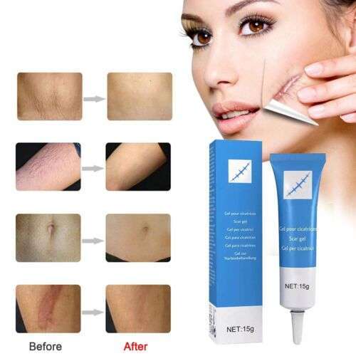 Effective Scar Removal: Repair Stretch Marks, Burns, and Acne Scars