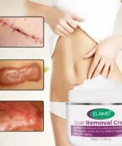 Anti-Acne Scar & Stretch Mark Removal Cream: Fade Blemishes & Repair Skin