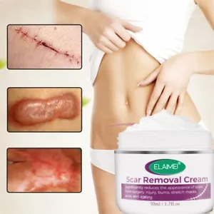 Anti-Acne Scar & Stretch Mark Removal Cream: Fade Blemishes & Repair Skin