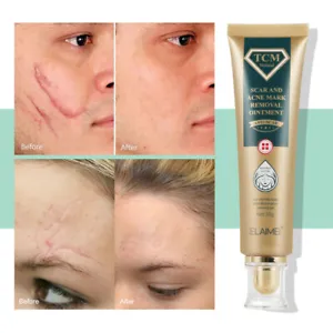 Acne Scar Removal Cream Gel: Erase Scars, Stretch Marks & Restore Smooth Skin