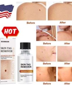स्किन टैग्स रिमूवर: मस्से हटाने और त्वचा को हाइड्रेट करने के लिए प्रभावी नेवस रिपेयर एसेंस