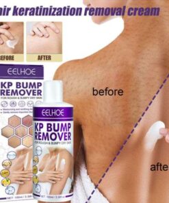 100ml Keratosis Pilaris Relief Cream: Exfoliating Treatment for Bumpy Skin