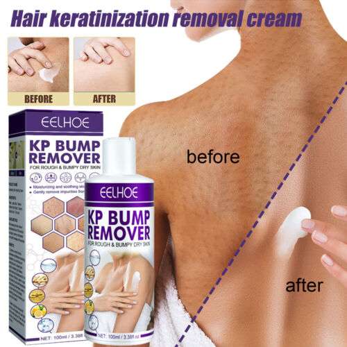 100ml Keratosis Pilaris Relief Cream: Exfoliating Treatment for Bumpy Skin