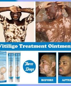 Vitiligo Miracle: Herbal Ointment for Ringworm and Skin Whitening